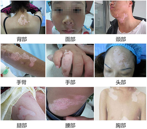 保定白癜风初期症状不容小视，小心白斑扩散